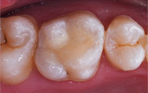 Smile Gallery - A2Z Dental - Before and After Photos